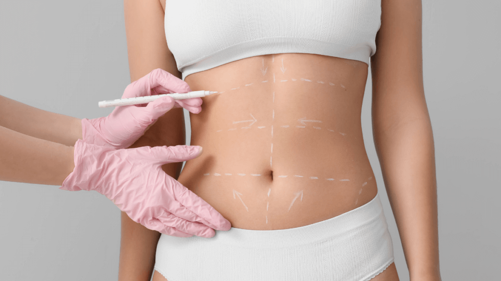 Imagine of abdominoplasty markings