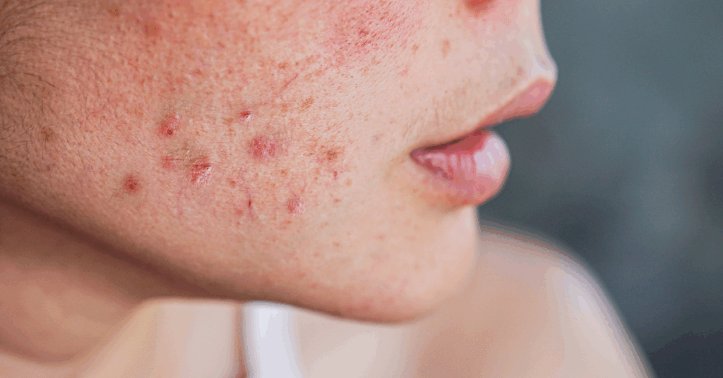 hormonal acne when investing in bridal beauty