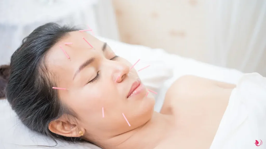 Acupuncture For Beauty