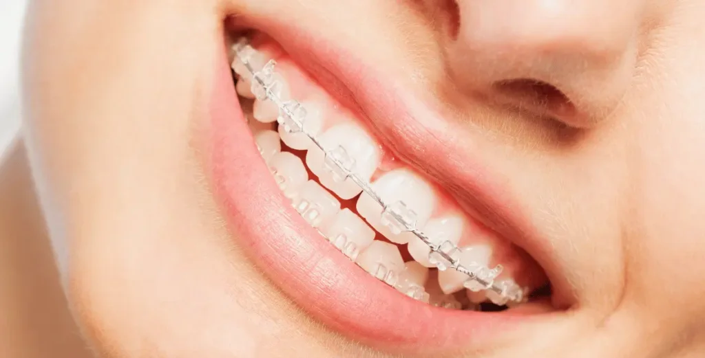 Braces and lip fillers
