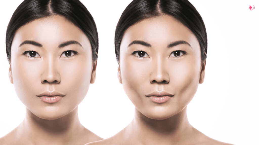 Buccal Fat Removal Celebrity Cheek Slimming Secret