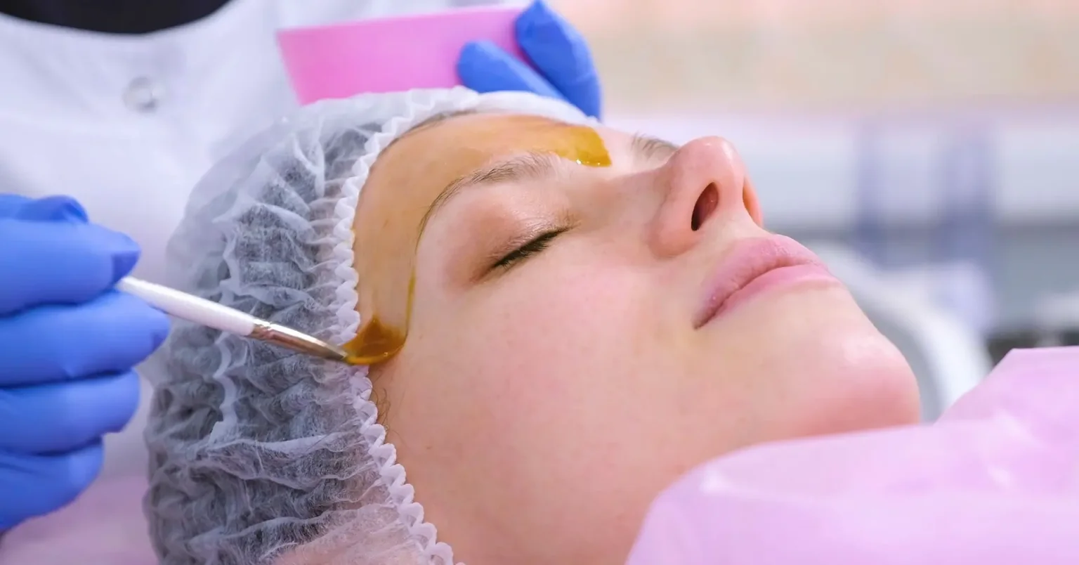 Chemical Peels