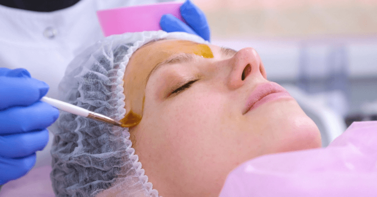 Everything You Need to Know About Chemical Peels