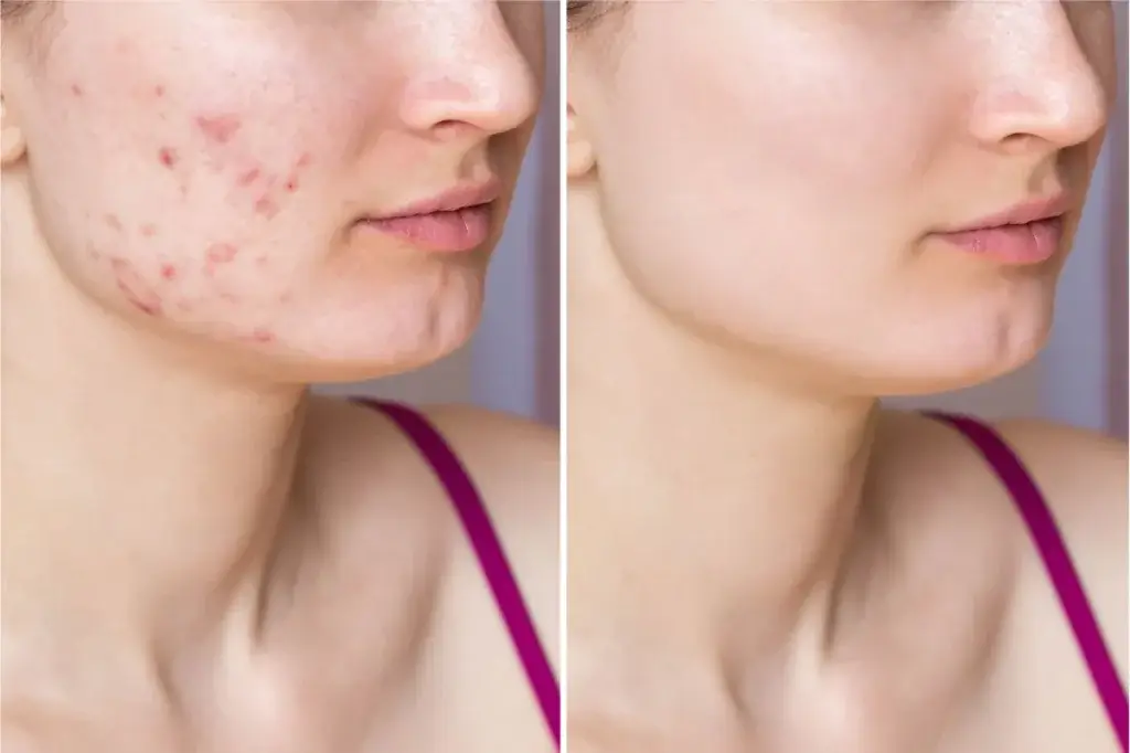 image of a woman struggling with acne and her results after using Co2 lasers