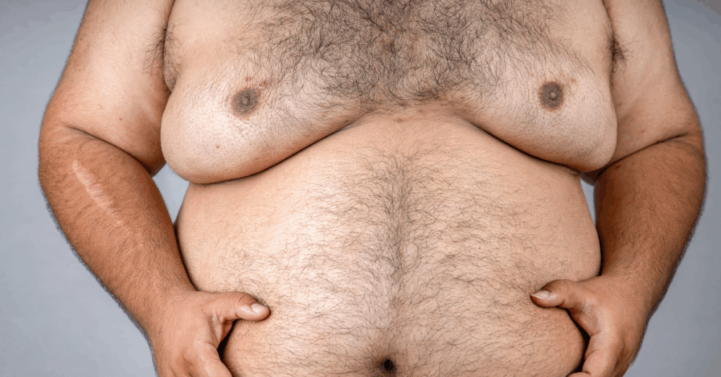 obesity can worsen gynaecomastia. here is an image of an obese man with the condition