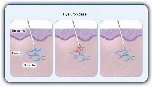 How Hyaluronidase works when it comes to filler reversal
