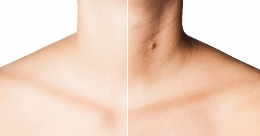 An image of a neck before and after treatment for neck bands to create a Swan Neck or reduce the appearance of neck bands.