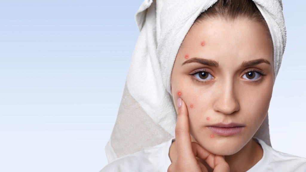 Women pointing out acne on her skin
