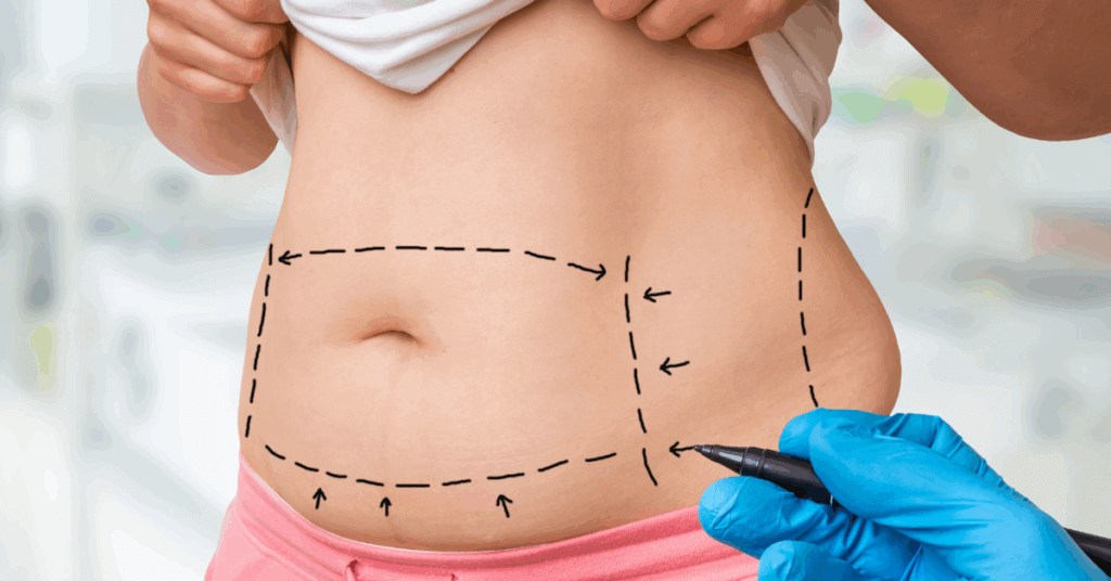 Liposuction pros