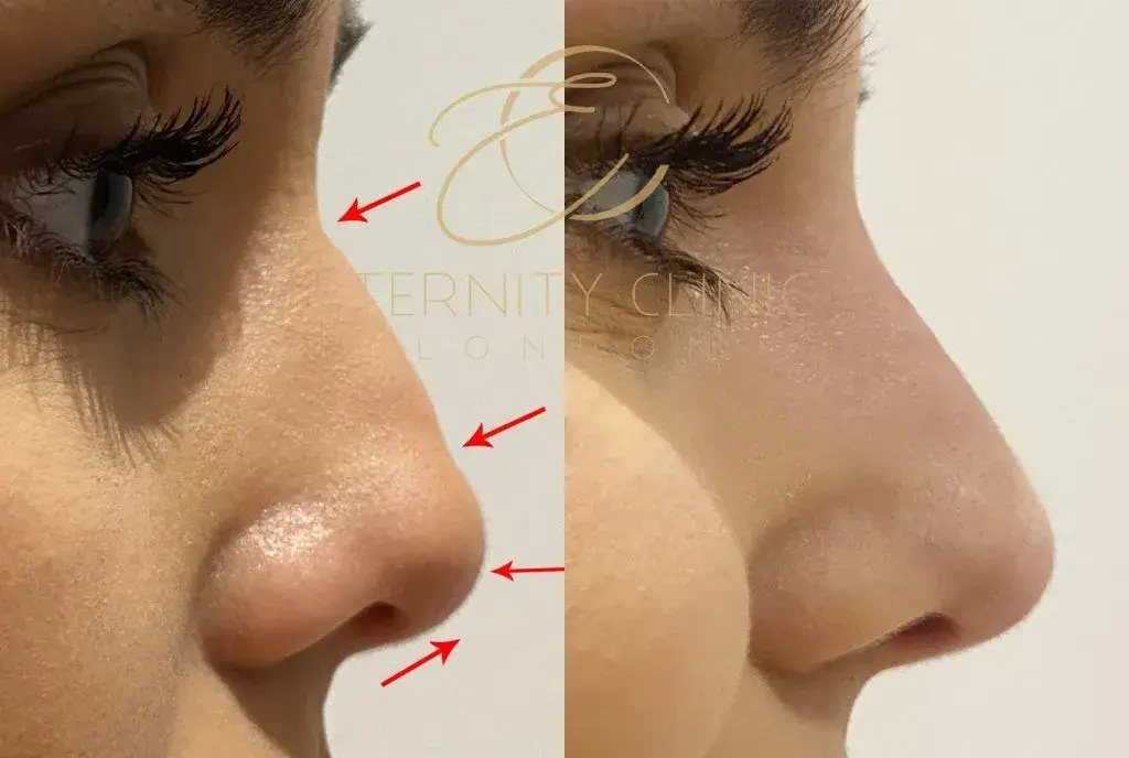 An image of the before and after images of a non-surgical nose jjob