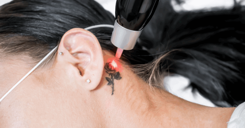 Picosecond Laser Technology for tattoo removal