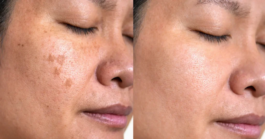 Pigmentation Facials