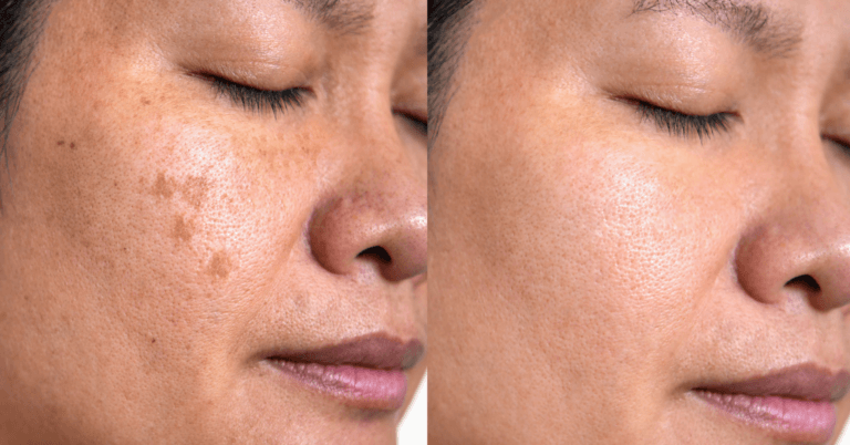 The Best Pigmentation Facials For You
