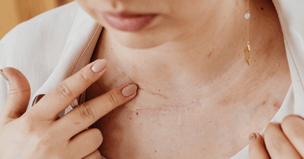 Reveal Your Best Skin With Scar Camouflage Treatments image of a woman with a scar on her collar bone for an article talking about scar camouflage tattooing