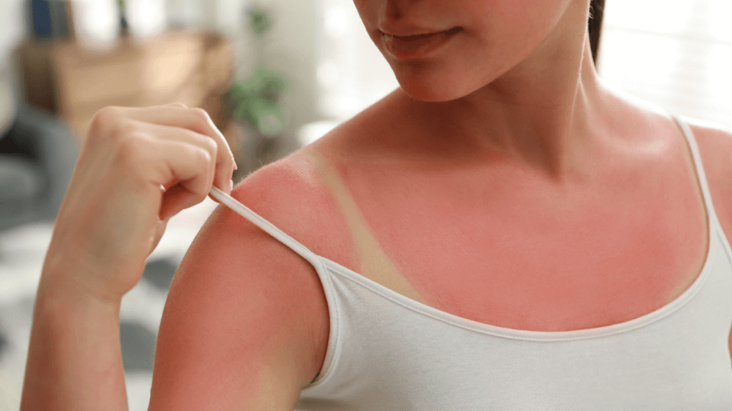 An image of a woman with sunburned skin