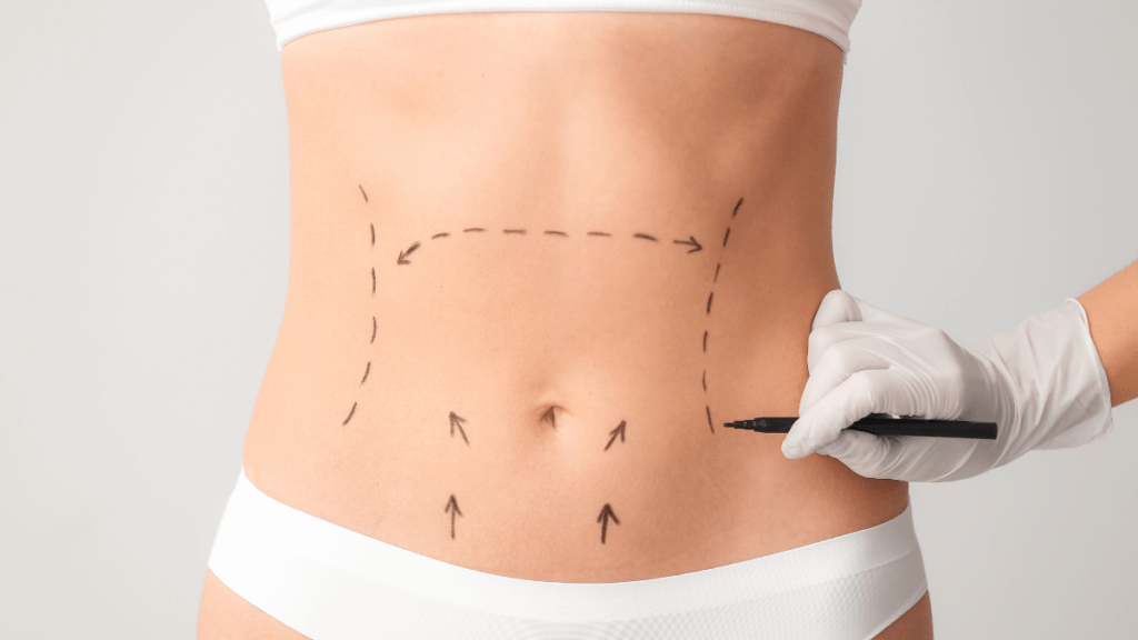 Image of a woman prepping for a tummy tuck