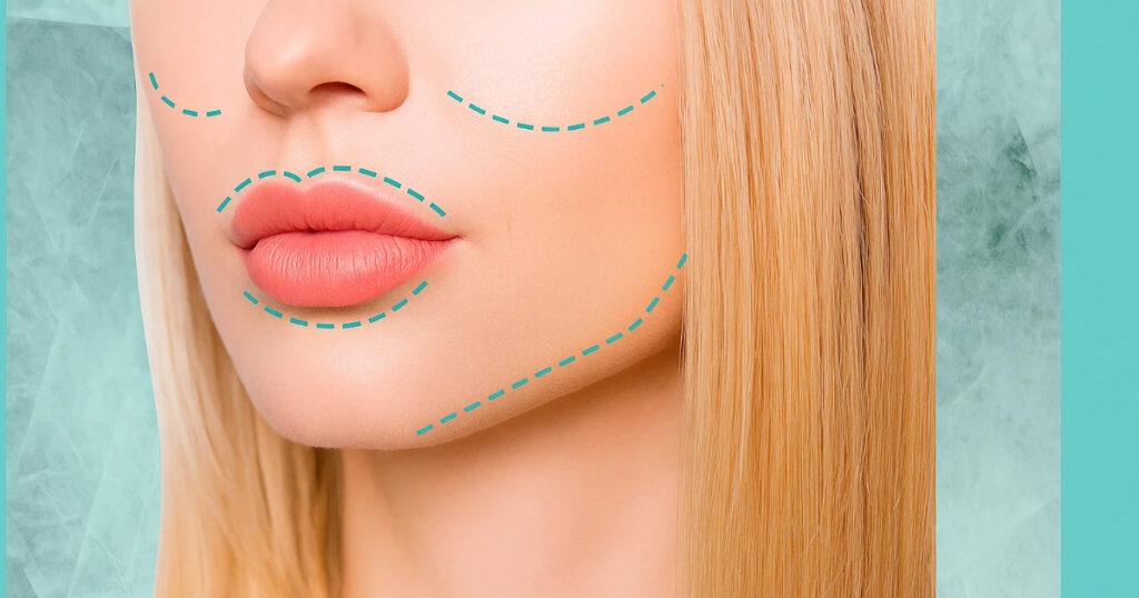 How ‘Tweakments’ Are Making A Noticeable Impact On The Beauty Industry Tweakments. An image of a women with surgical/aesthetic treatment preparation lines on here face