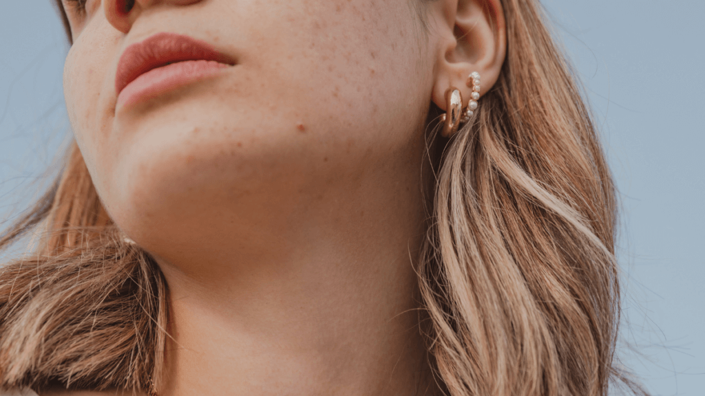 An image of a women with facial pigmentation or potential acne scarring