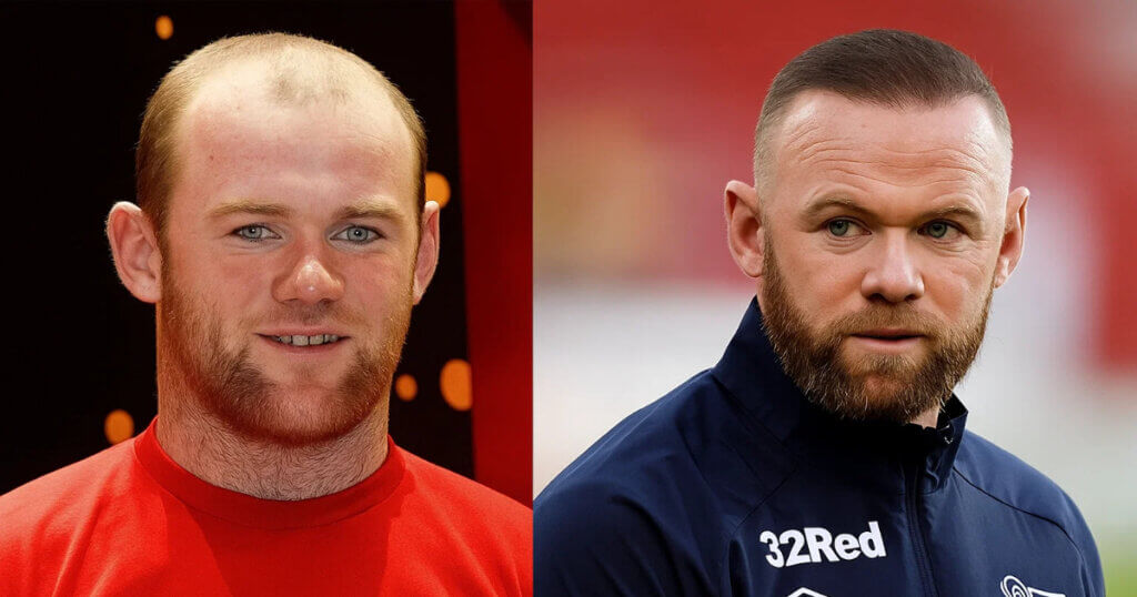 An image of Wayne Rooney before and after undergoing surgical hair transplants