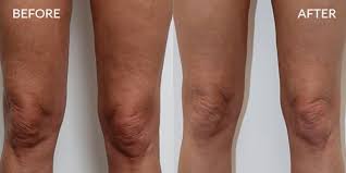 Thermage Before & After legs