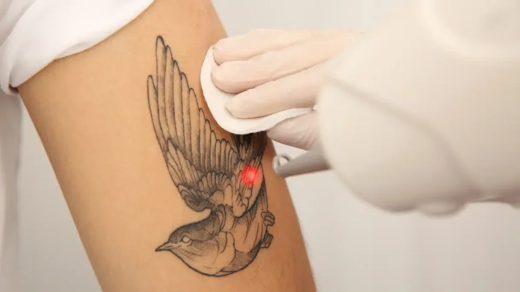 tattoo removal